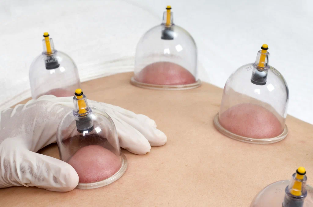 Hijama Therapy