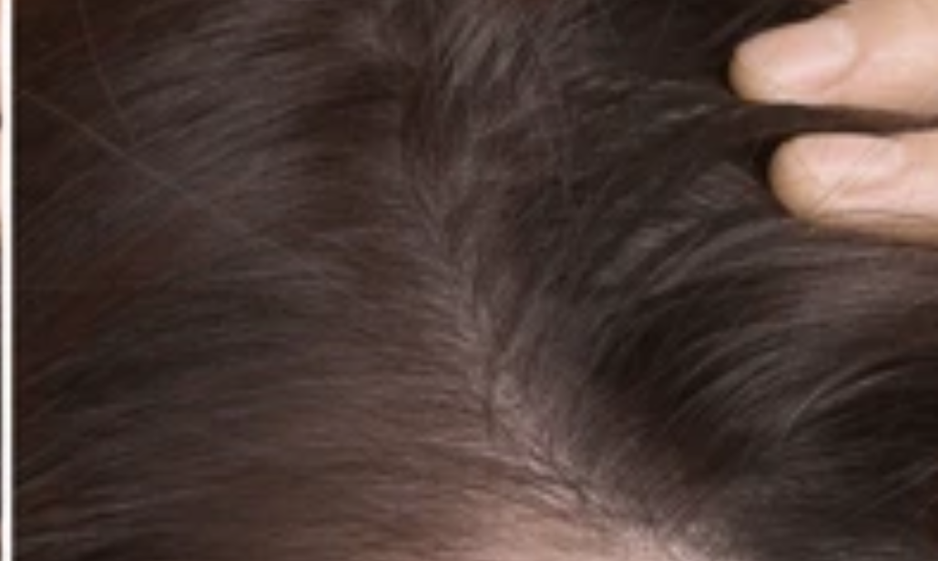 after scalp health treatment