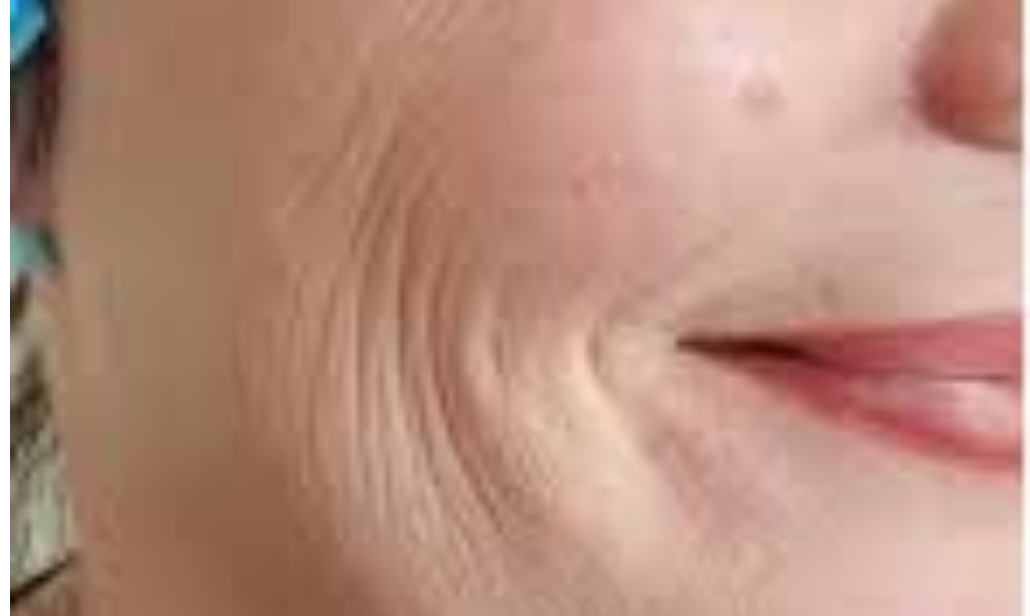 before skin booster treatment