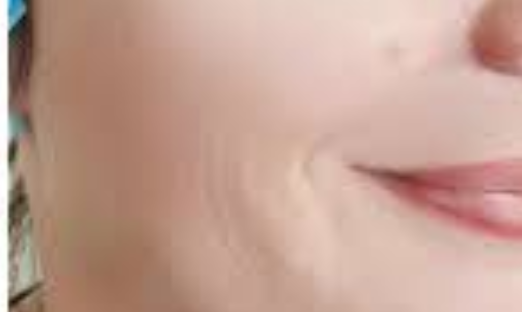 after skin booster treatment