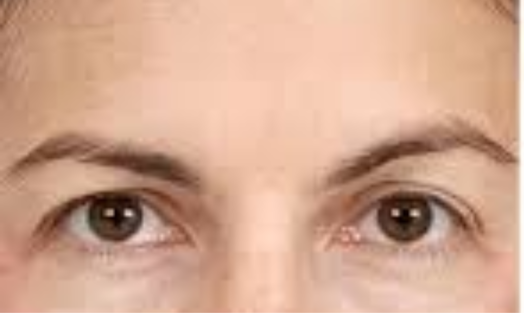 before eyebrow lift at Skin Esthetics Clinic Romford