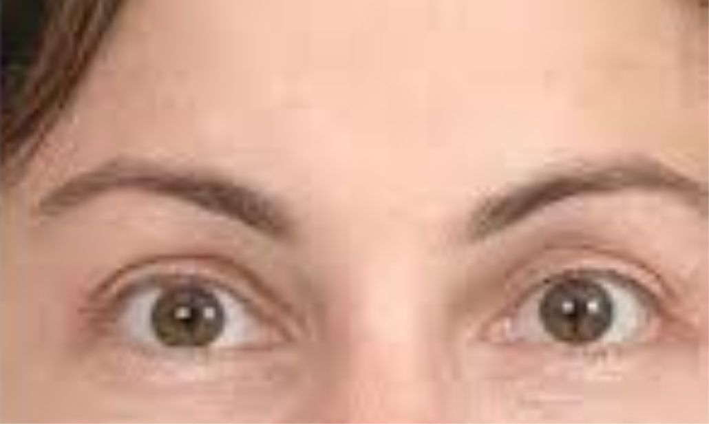 after eyebrow lift at Skin Esthetics Clinic Romford
