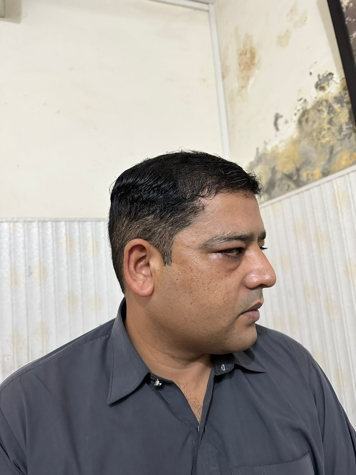 Hair loss treatment at Skin Esthetics Clinic